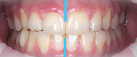 attivatori elastici ortodontici
