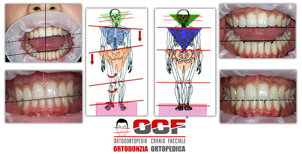 descompensa cionpostural